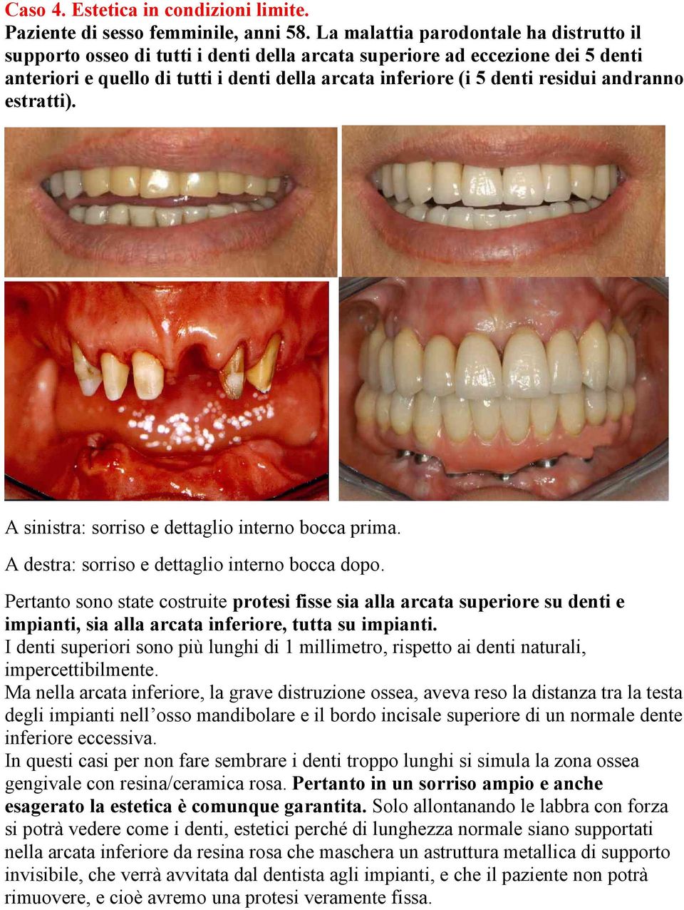 andranno estratti). A sinistra: sorriso e dettaglio interno bocca prima. A destra: sorriso e dettaglio interno bocca dopo.