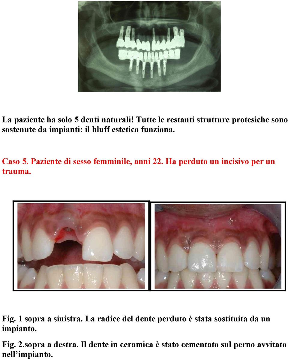 Caso 5. Paziente di sesso femminile, anni 22. Ha perduto un incisivo per un trauma. Fig.