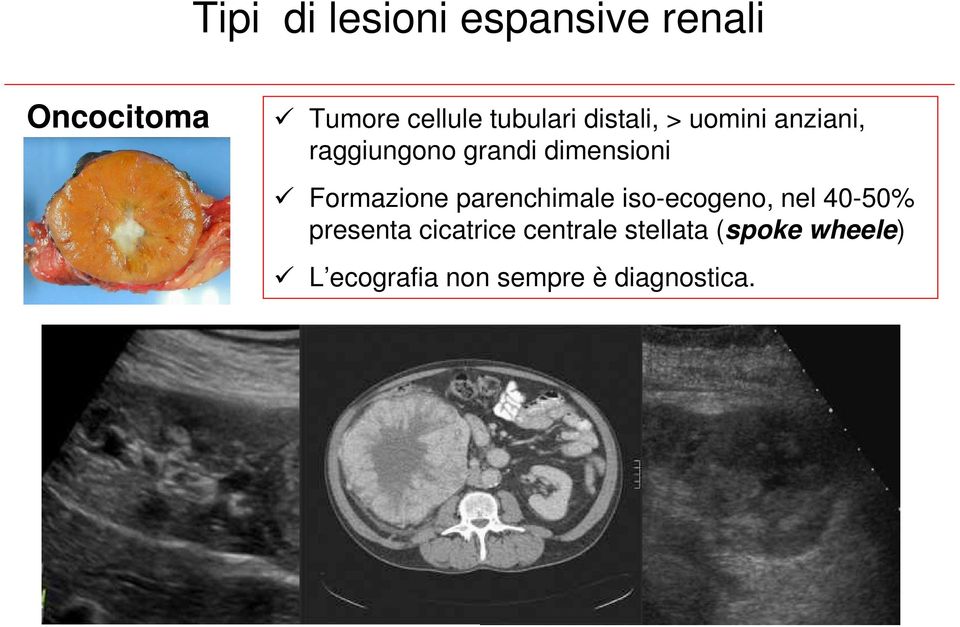 Formazione parenchimale iso-ecogeno, nel 40-50% presenta