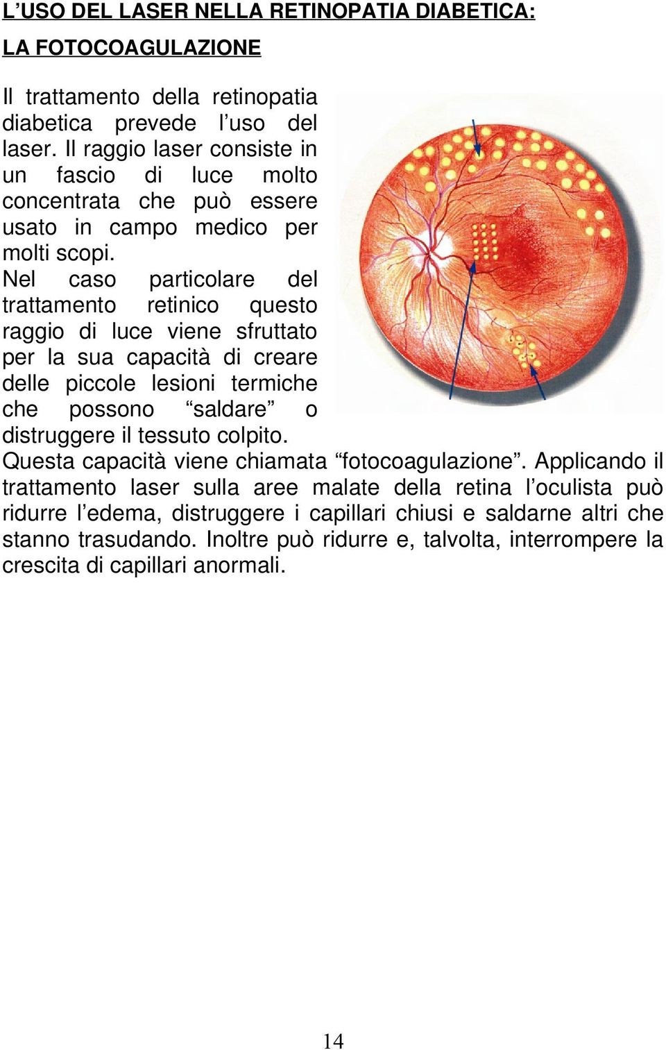 Nel caso particolare del trattamento retinico questo raggio di luce viene sfruttato per la sua capacità di creare delle piccole lesioni termiche che possono saldare o distruggere il