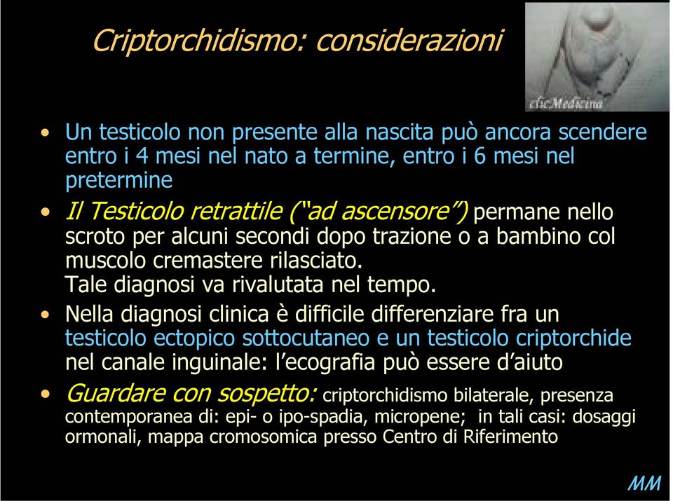 Nella diagnosi clinica è difficile differenziare fra un testicolo ectopico sottocutaneo e un testicolo criptorchide nel canale inguinale: l ecografia può essere d aiuto