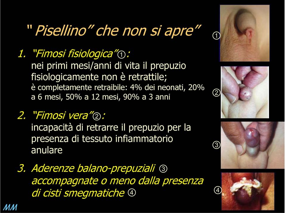 completamente retraibile: 4% dei neonati, 20% a 6 mesi, 50% a 12 mesi, 90% a 3 anni 2.