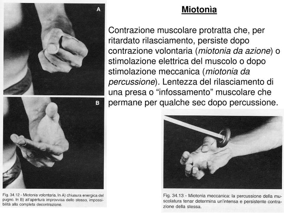 muscolo o dopo stimolazione meccanica (miotonia da percussione).