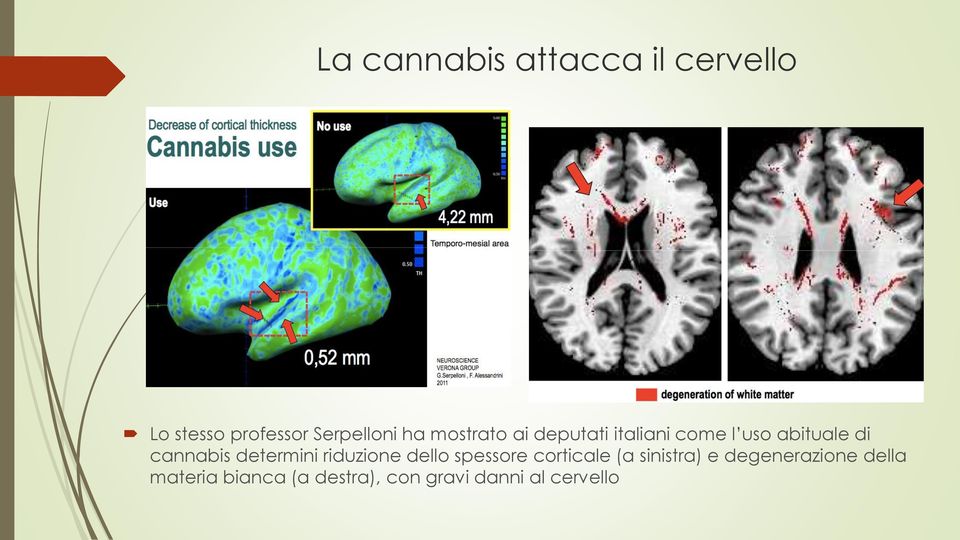 determini riduzione dello spessore corticale (a sinistra) e