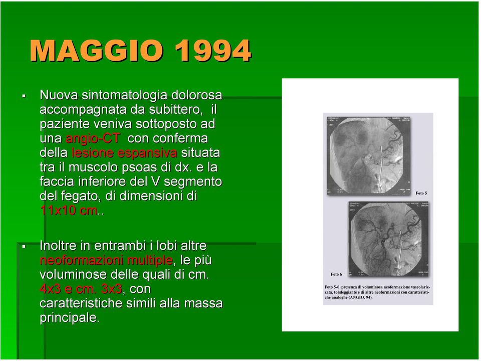 e la faccia inferiore del V segmento del fegato, di dimensioni di 11x10 cm.