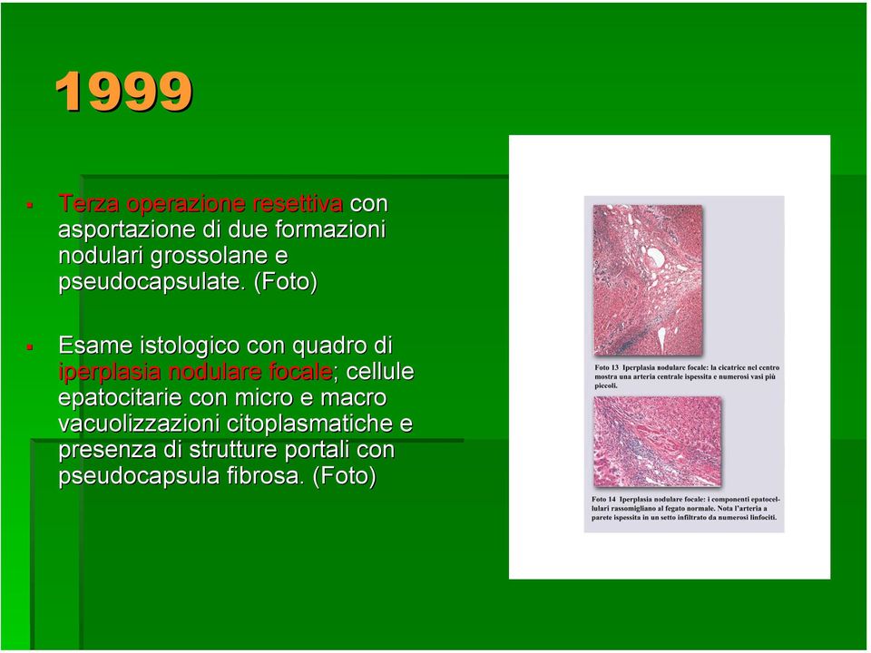 (Foto) Esame istologico con quadro di iperplasia nodulare focale; ; cellule