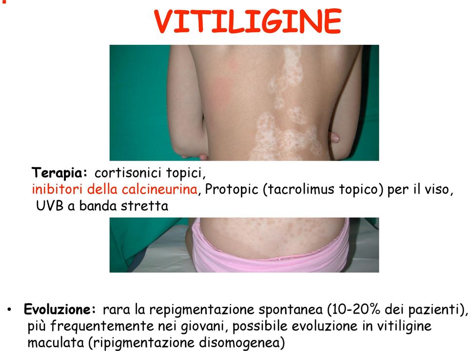 rara la repigmentazione spontanea (10-20% dei pazienti), più frequentemente