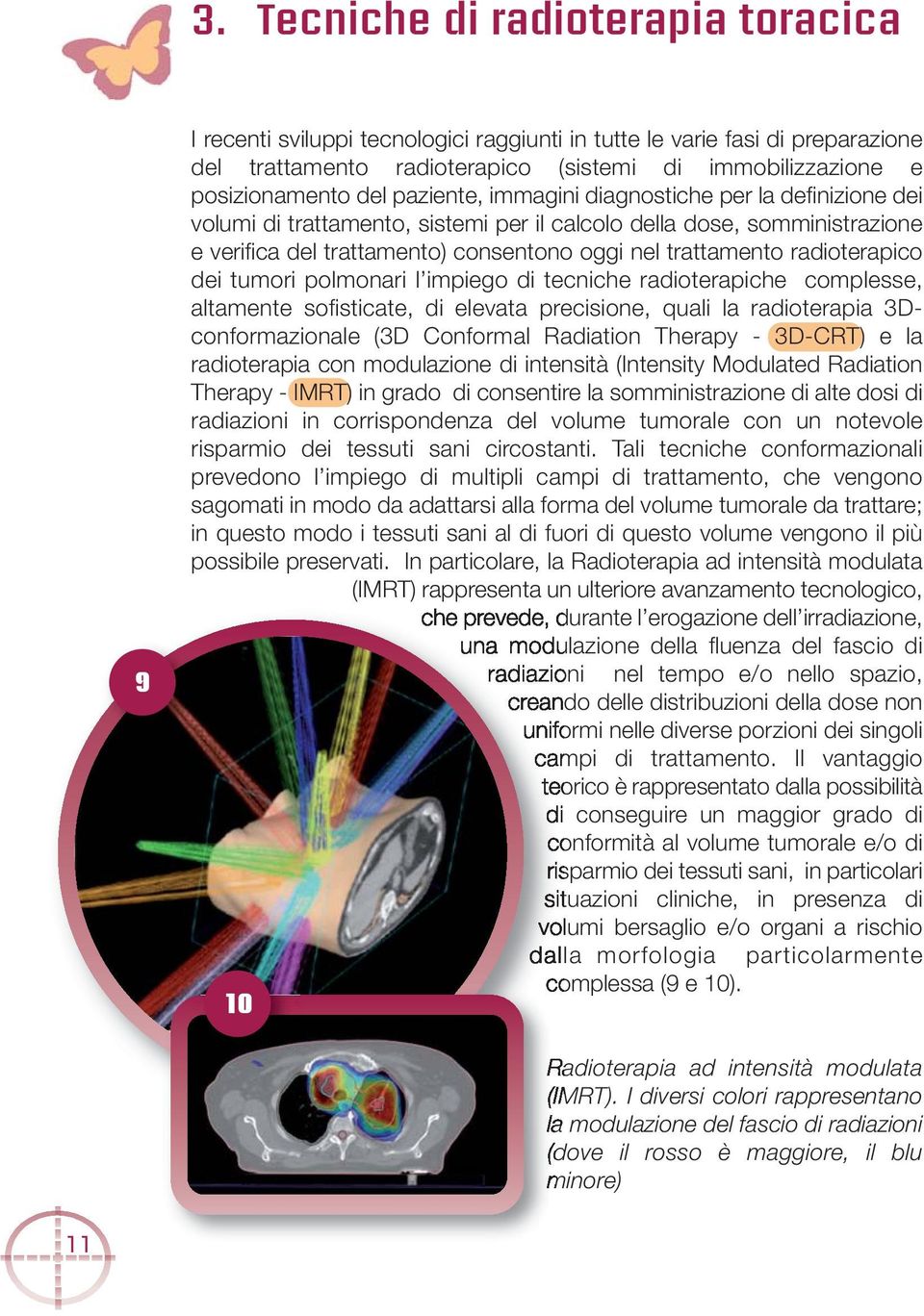 radioterapico dei tumori polmonari l impiego di tecniche radioterapiche complesse, altamente sofisticate, di elevata precisione, quali la radioterapia 3Dconformazionale (3D Conformal Radiation