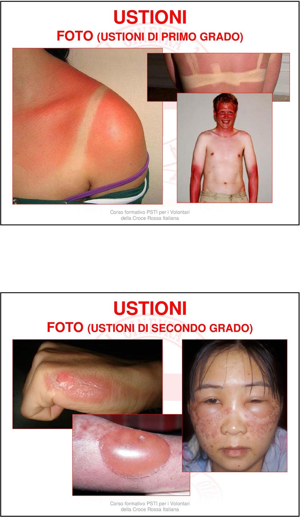 GRADO)  (USTIONI DI