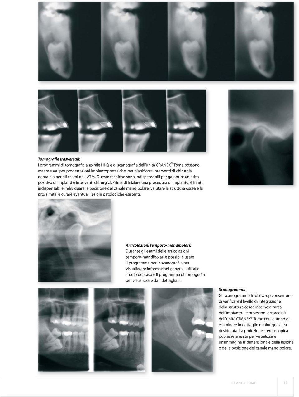 Prima di iniziare una procedura di impianto, è infatti indispensabile individuare la posizione del canale mandibolare, valutare la struttura ossea e la prossimità, e curare eventuali lesioni