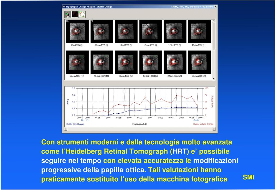 elevata accuratezza le modificazioni progressive della papilla ottica.