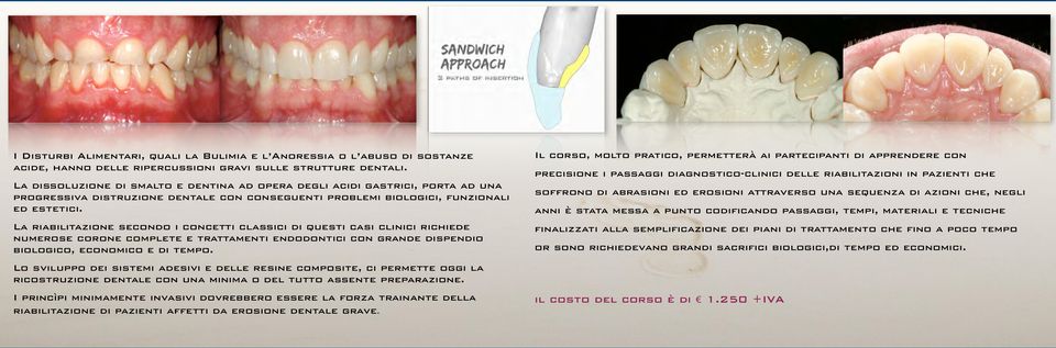 La riabilitazione secondo i concetti classici di questi casi clinici richiede numerose corone complete e trattamenti endodontici con grande dispendio biologico, economico e di tempo.