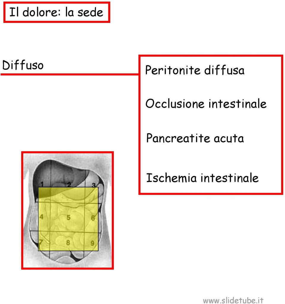 Occlusione intestinale