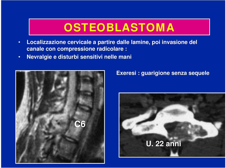 compressione radicolare : Nevralgie e disturbi