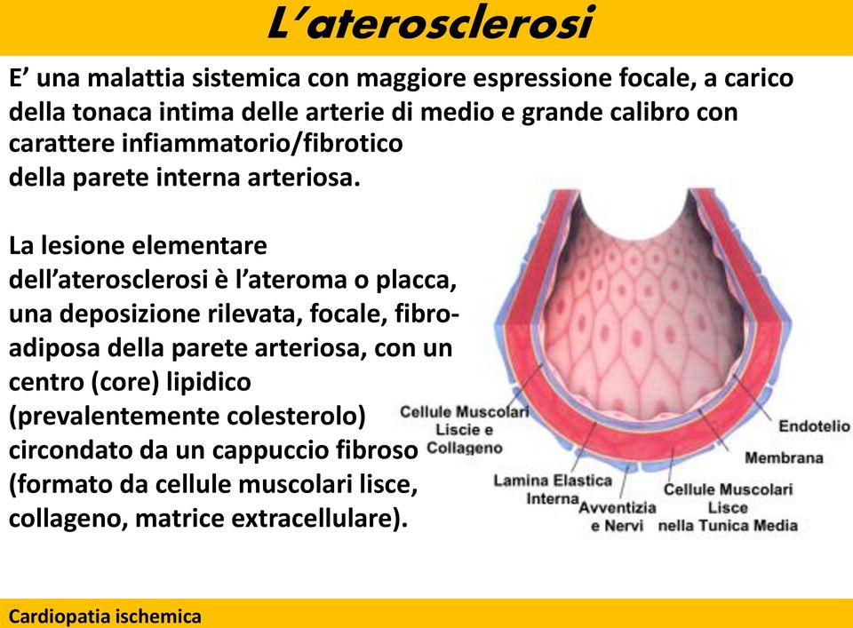 La lesione elementare dell aterosclerosi è l ateroma o placca, una deposizione rilevata, focale, fibroadiposa della parete arteriosa,