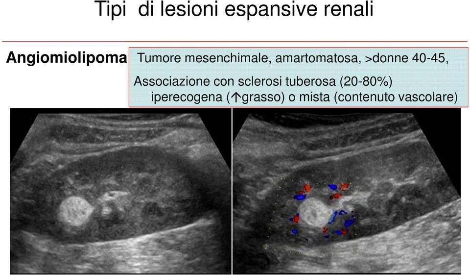 40-45, Associazione con sclerosi tuberosa