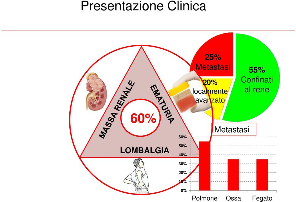 Metastasi 20% localmente avanzato