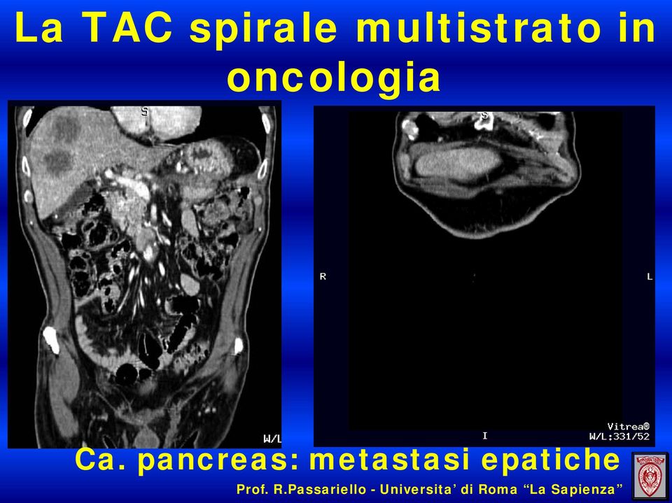 pancreas: metastasi epatiche