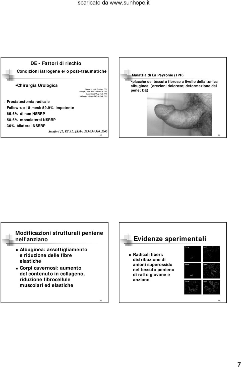 fibroso a livello della tunica albuginea (erezioni dolorose; deformazione del pene; DE) Stanford JL, ET AL. JAMA.