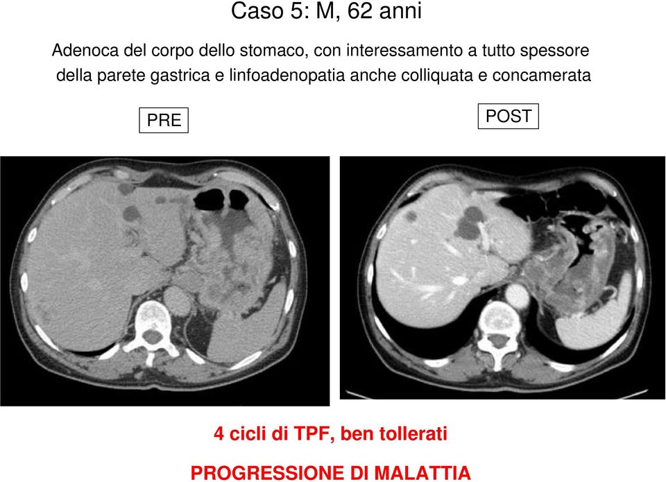 linfoadenopatia anche colliquata e concamerata PRE POST