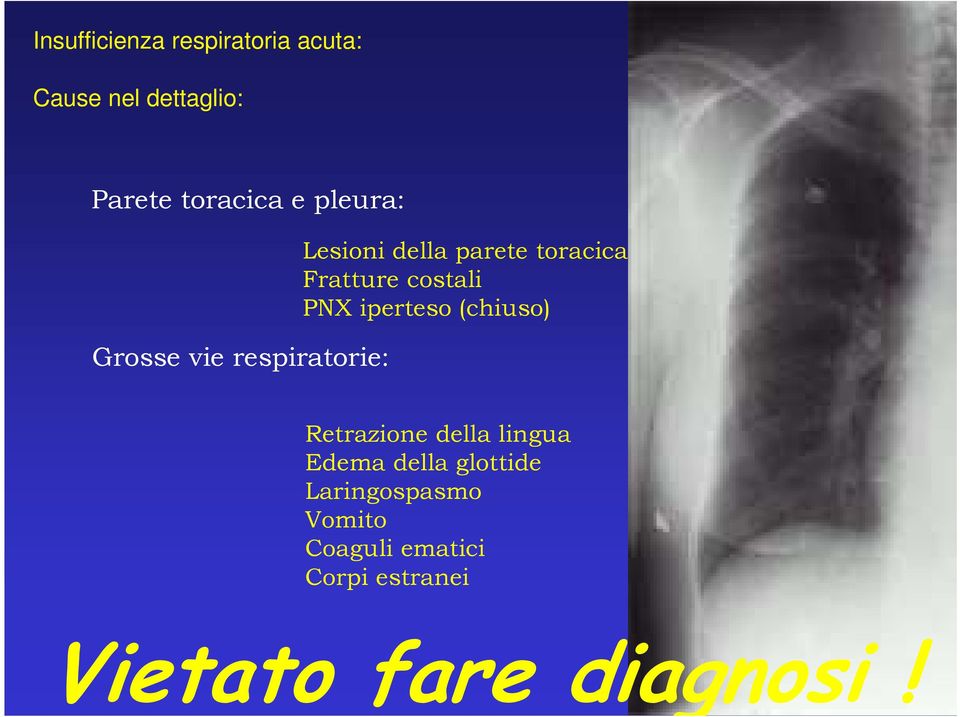 costali PNX iperteso (chiuso) Retrazione della lingua Edema della