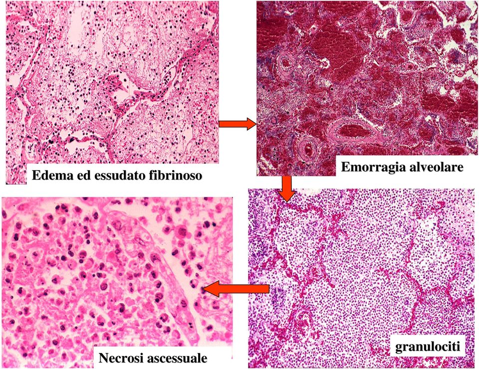 alveolare Necrosi