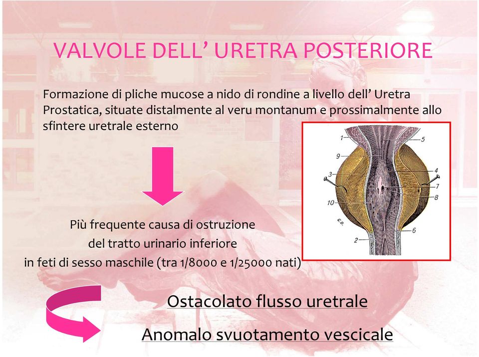 uretrale esterno Più frequente causa di ostruzione del tratto urinario inferiore in feti di