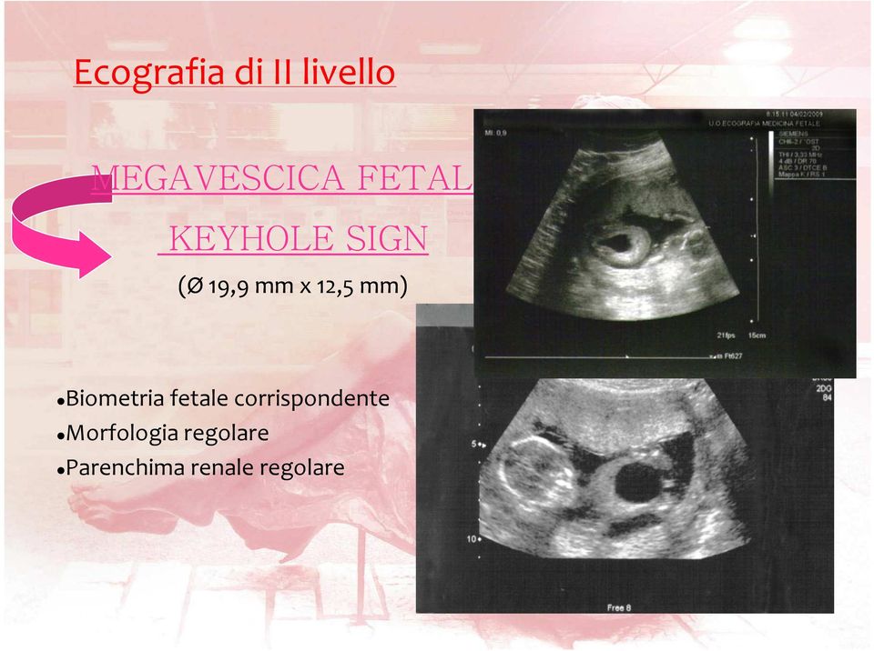 mm) Biometria fetale corrispondente
