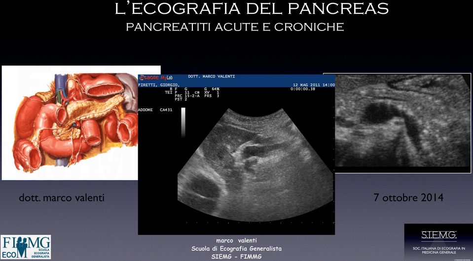 pancreatiti acute e