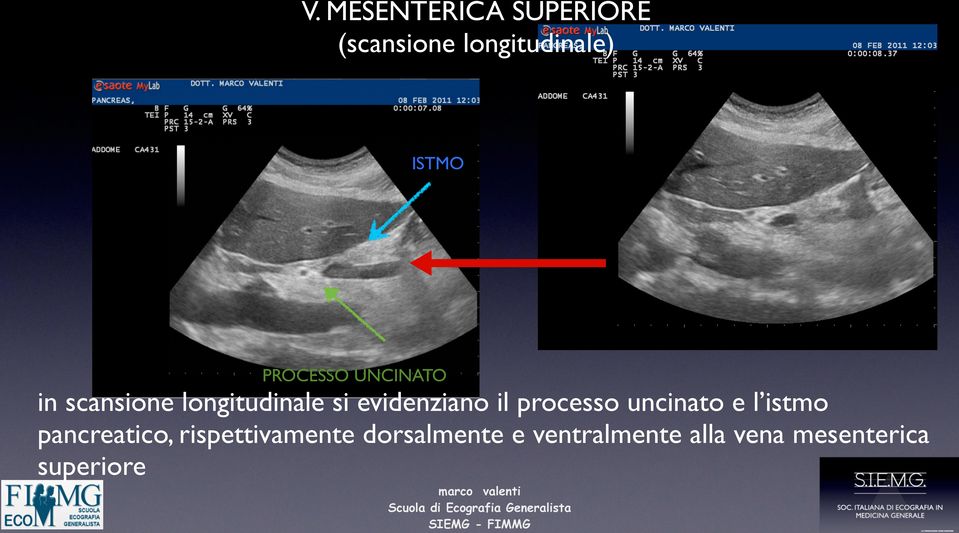 evidenziano il processo uncinato e l istmo pancreatico,