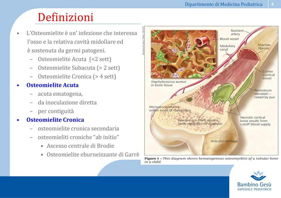 Osteomielite Acuta (<2 sett) Osteomielite Subacuta (> 2 sett) Osteomielite Cronica (> 4 sett) Osteomielite Acuta acuta