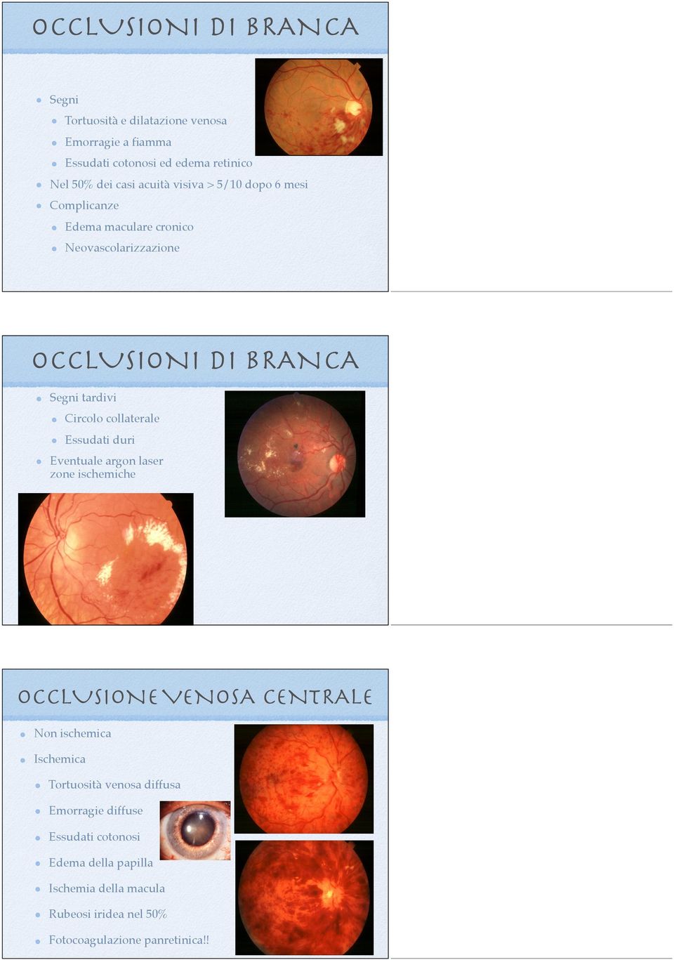 collaterale Essudati duri Eventuale argon laser zone ischemiche OCCLUSIONE VENOSA CENTRALE Non ischemica Ischemica Tortuosità venosa