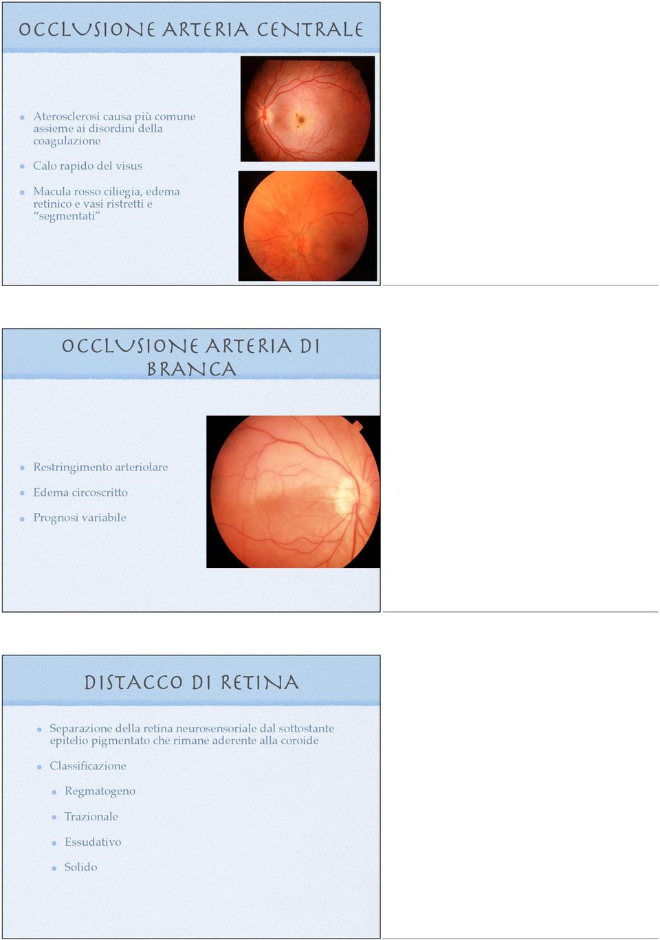 Restringimento arteriolare Edema circoscritto Prognosi variabile DISTACCO DI RETINA Separazione della retina