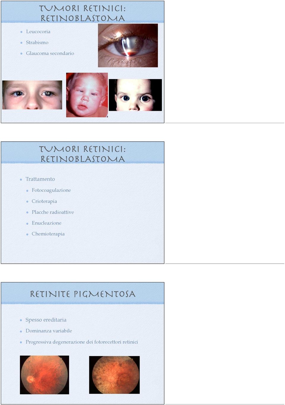 Placche radioattive Enucleazione Chemioterapia RETINITE PIGMENTOSA Spesso