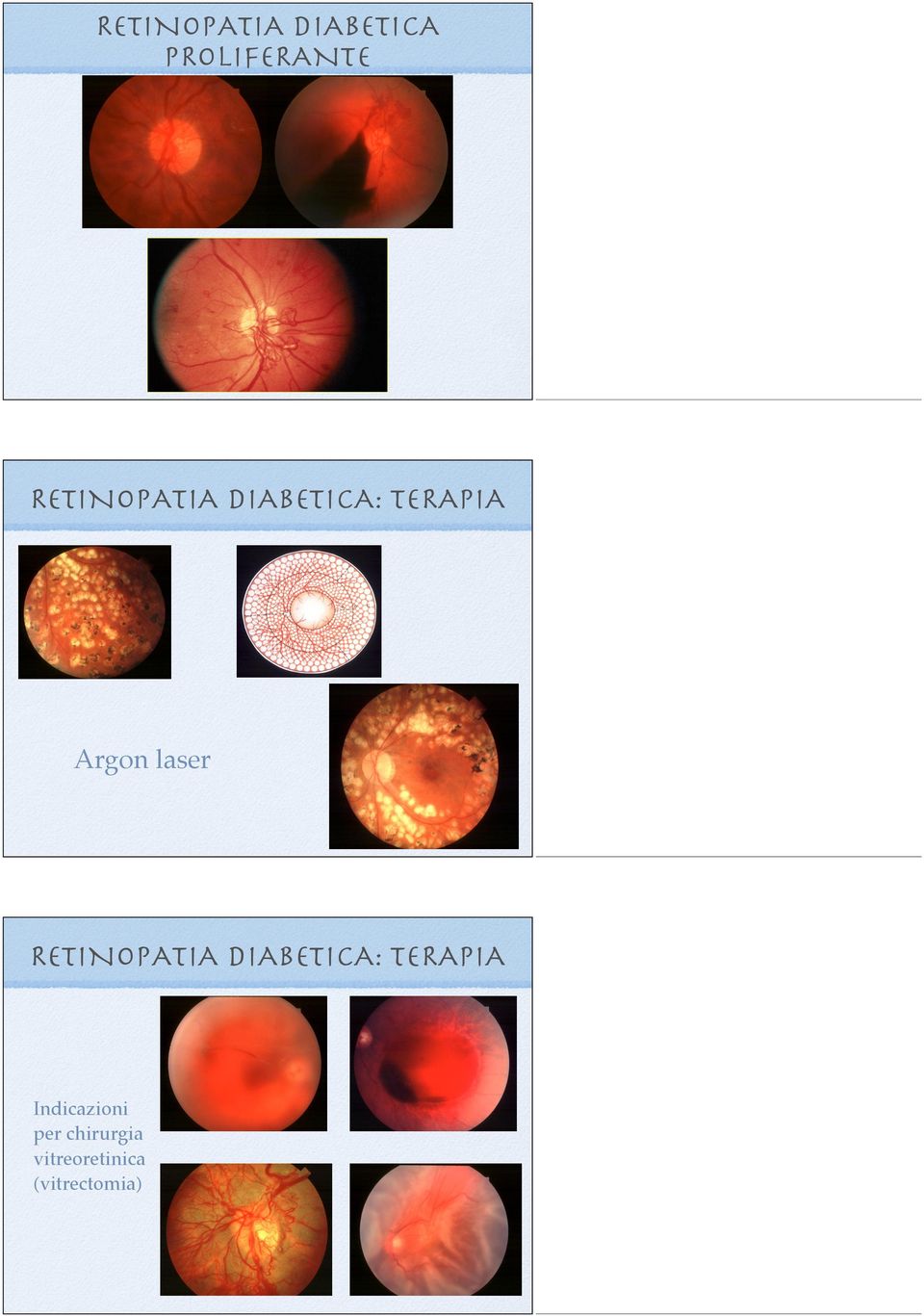 laser RETINOPATIA DIABETICA: TERAPIA