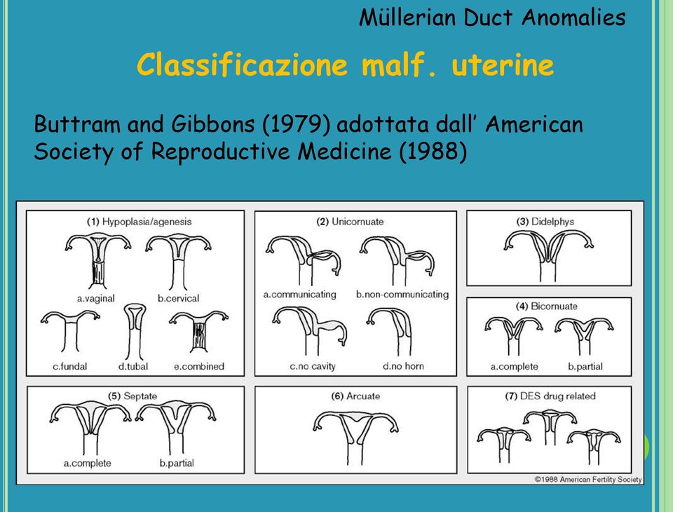 uterine Buttram and Gibbons (1979)
