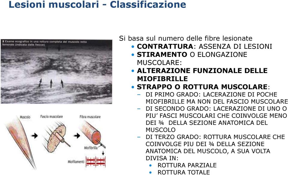 FASCIO MUSCOLARE DI SECONDO GRADO: LACERAZIONE DI UNO O PIU FASCI MUSCOLARI CHE COINVOLGE MENO DEI ¾ DELLA SEZIONE ANATOMICA DEL MUSCOLO DI