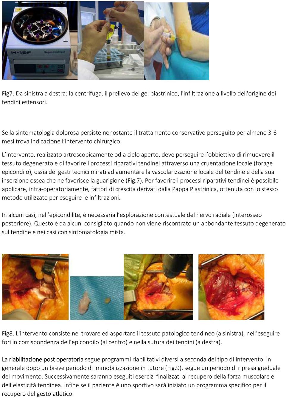 L intervento, realizzato artroscopicamente od a cielo aperto, deve perseguire l obbiettivo di rimuovere il tessuto degenerato e di favorire i processi riparativi tendinei attraverso una cruentazione