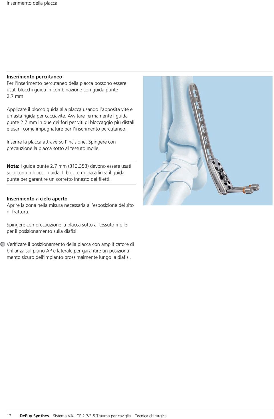 7 mm in due dei fori per viti di bloccaggio più distali e usarli come impugnature per l inserimento percutaneo. Inserire la placca attraverso l incisione.