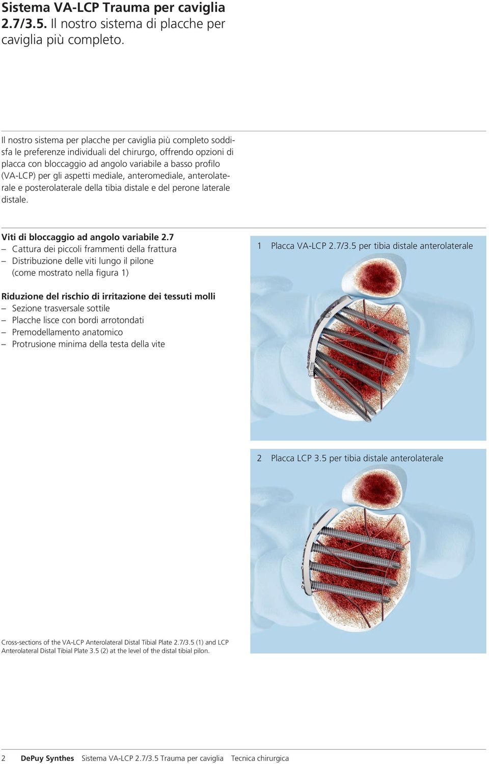 aspetti mediale, anteromediale, anterolaterale e posterolaterale della tibia distale e del perone laterale distale. Viti di bloccaggio ad angolo variabile 2.