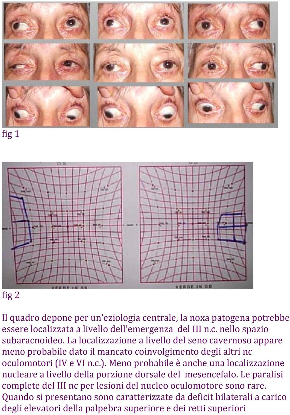 Meno probabile è anche una localizzazione nucleare a livello della porzione dorsale del mesencefalo.