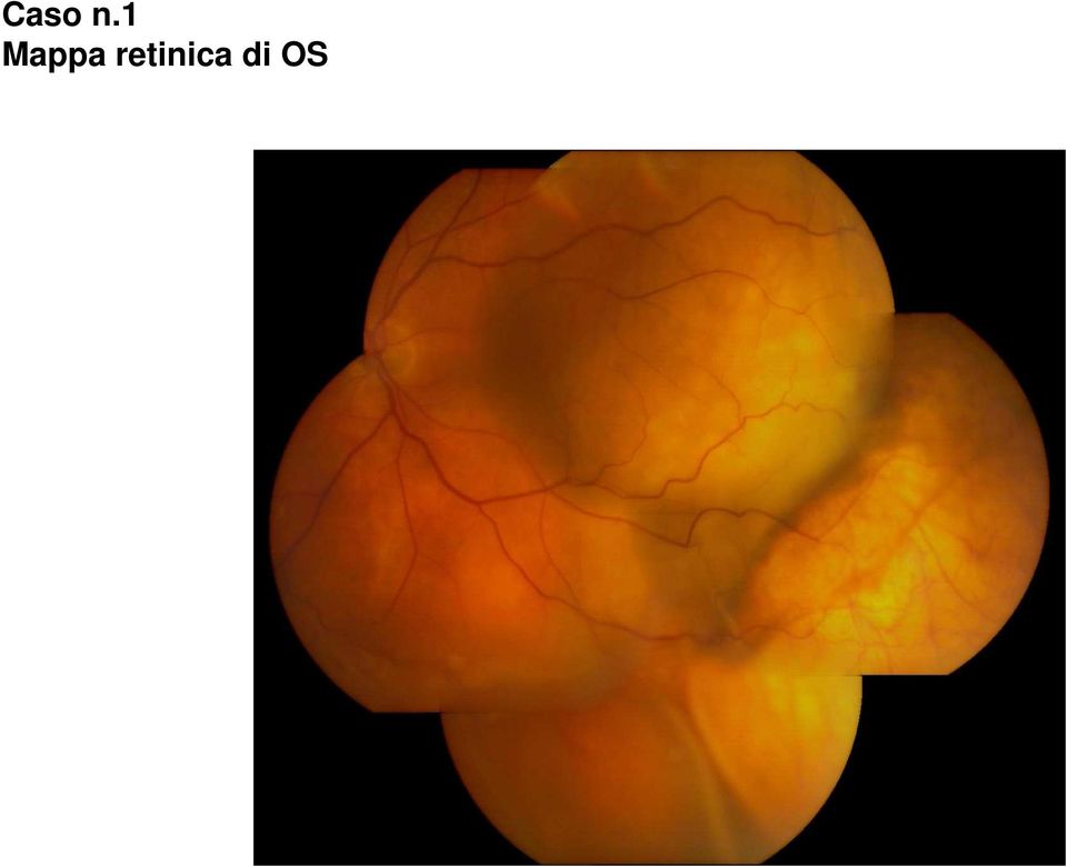 retinica