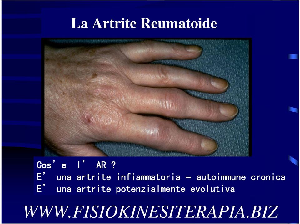autoimmune cronica E una artrite