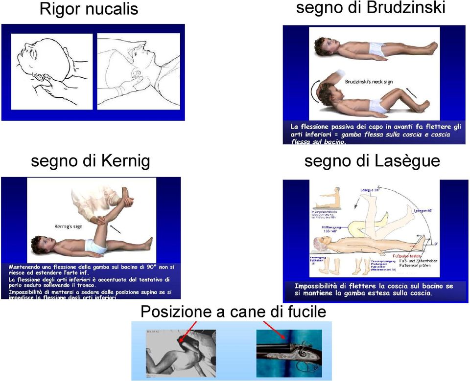 Kernig segno di Lasègue