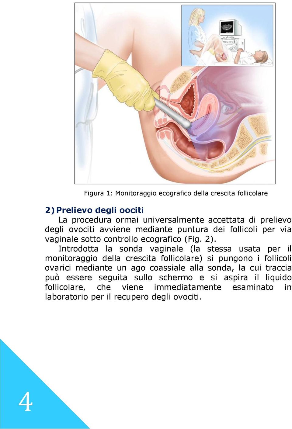 Introdotta la sonda vaginale (la stessa usata per il monitoraggio della crescita follicolare) si pungono i follicoli ovarici mediante un ago