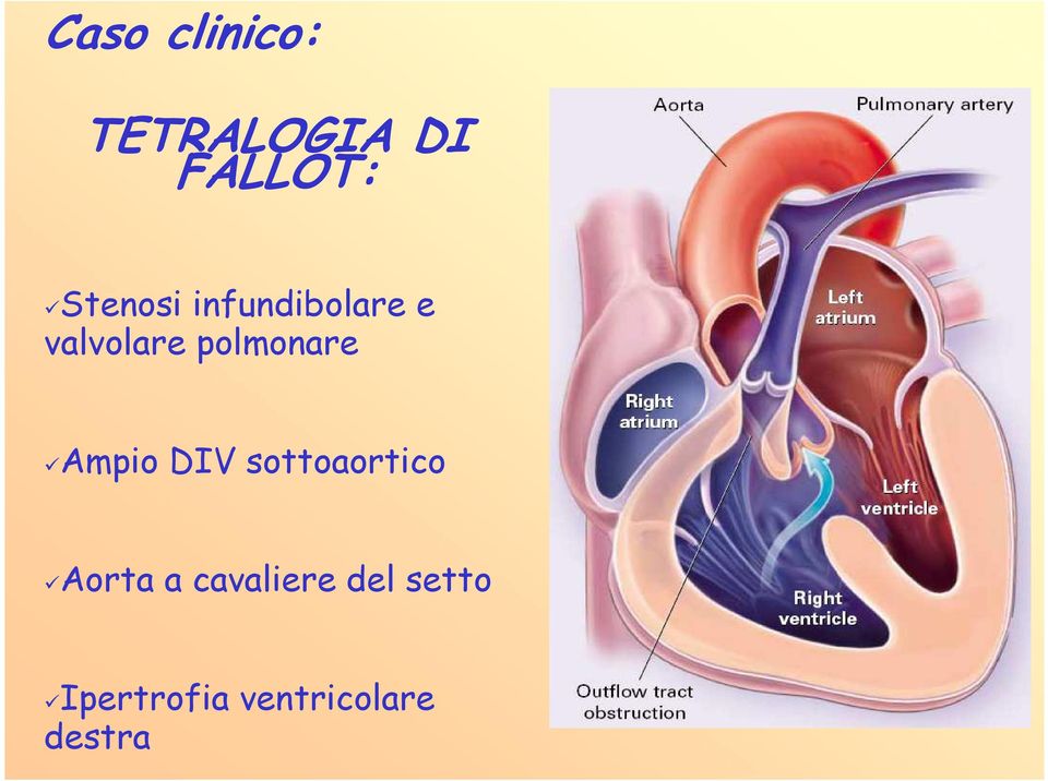 polmonare Ampio DIV sottoaortico Aorta a