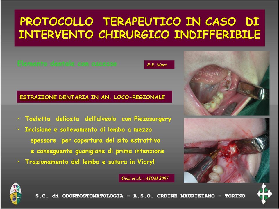 LOCO-REGIONALE Toeletta delicata dell alveolo con Piezosurgery Incisione e sollevamento di lembo a