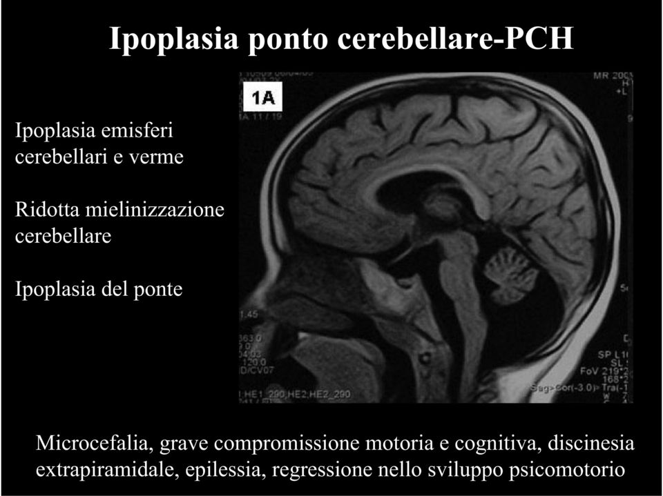 Microcefalia, grave compromissione motoria e cognitiva,