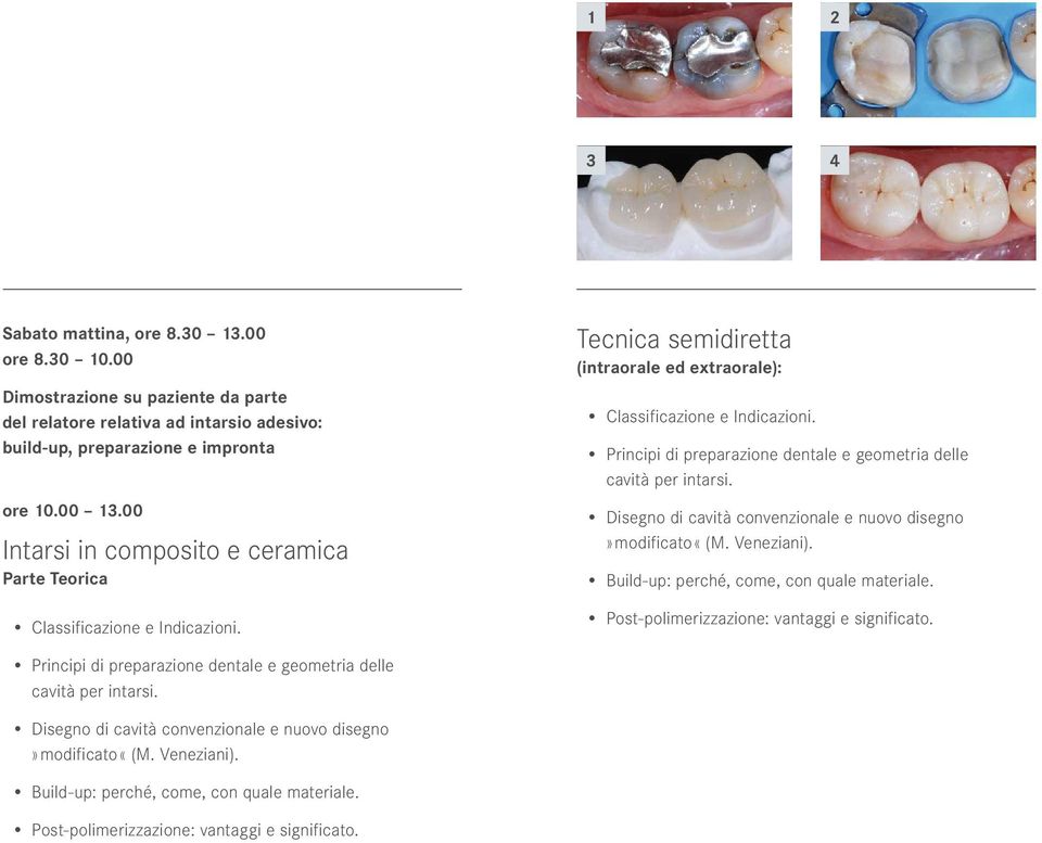 Principi di preparazione dentale e geometria delle cavità per intarsi. Disegno di cavità convenzionale e nuovo disegno» modificato «(M. Veneziani). Build-up: perché, come, con quale materiale.