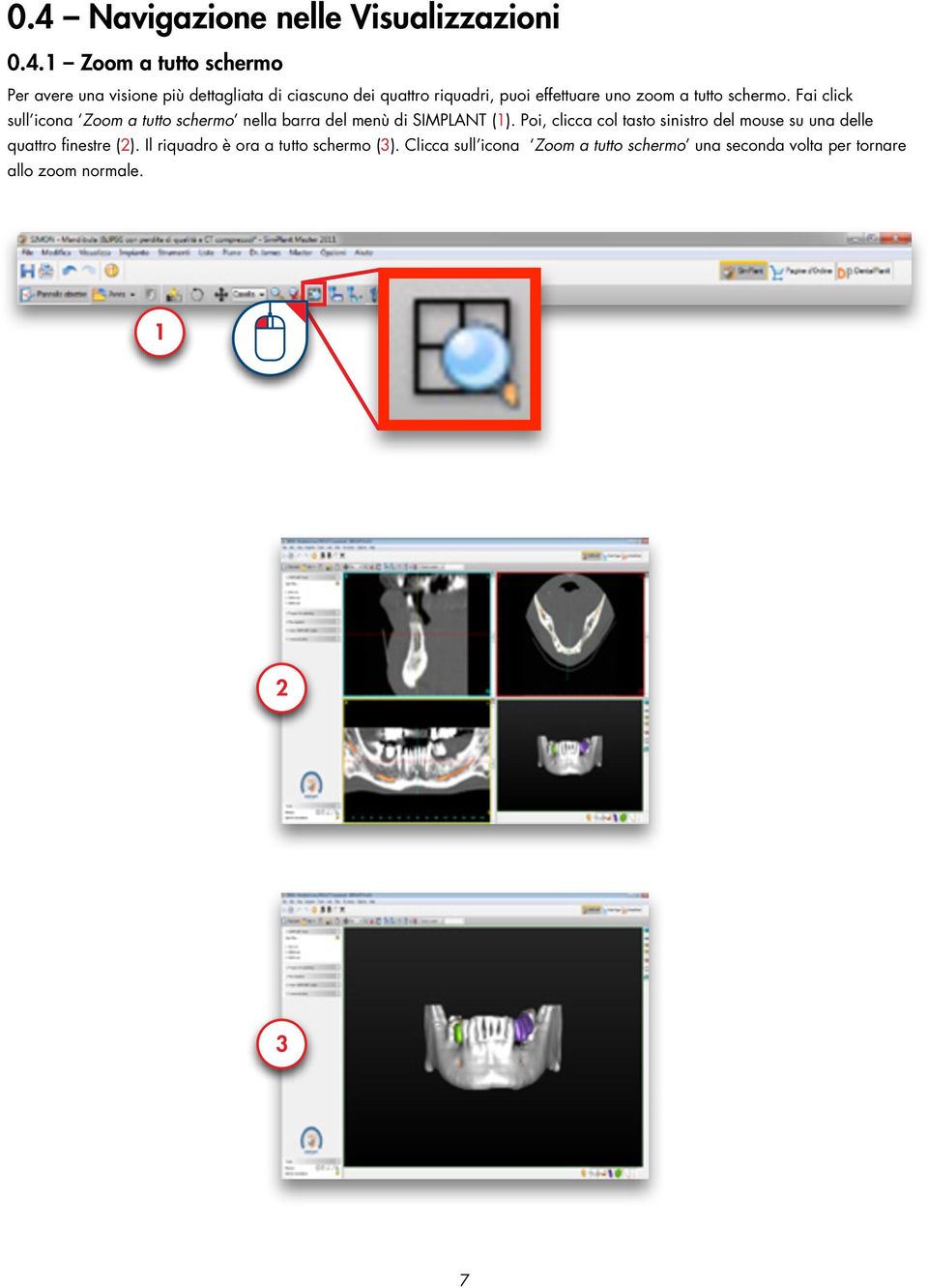 Fai click sull icona Zoom a tutto schermo nella barra del menù di SIMPLANT (1).
